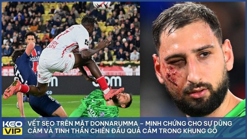 Vết sẹo trên mặt Donnarumma – minh chứng cho sự dũng cảm và tinh thần chiến đấu quả cảm trong khung gỗ